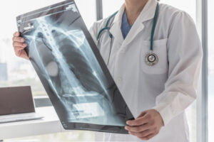 Why Choose De Castroverde Law Group After Suffering a Chest Injury in a Car Crash