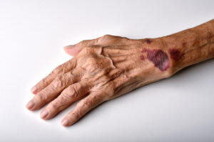 What is Nursing Home Abuse?